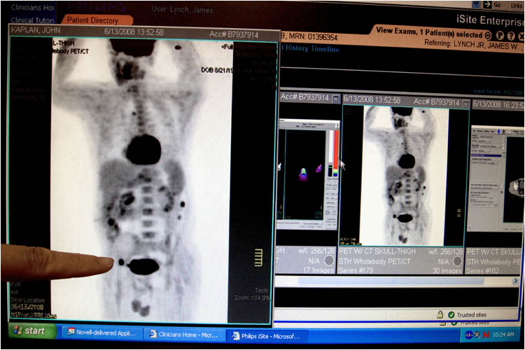 <b>A Complicated Case</b><br>The scan showed bad news. Two totally unrelated cases of Non-Hodgkin's Lymphoma were co-existing in my body at the same time.